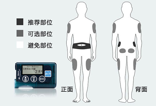 <a href='http://www.zkydsb.com/news-hy/27.html' target='_blank'><u>智凯胰岛素泵</u></a>植入部位